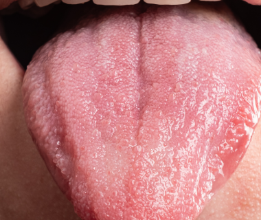 Candida orale da stress, cos’è e perchè viene